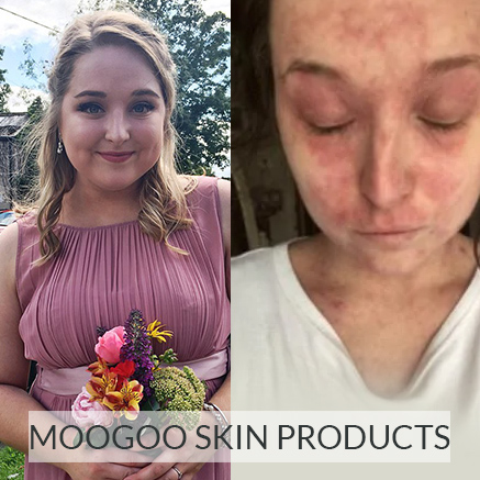 MooGoo Skin Products Change Teacher’s Life MooGoo Skin Products Change Teacher’s Life